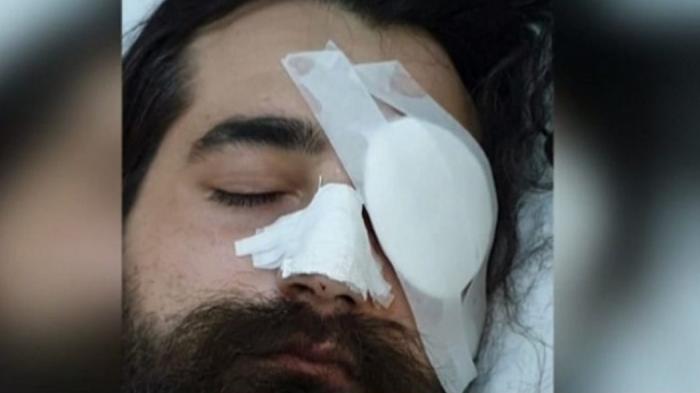 Συγκλονίζει ο φίλαθλος που έχασε το μάτι του: «Εγκληματική επίθεση από άνδρα των ΜΑΤ» (vid) | panathinaikos24.gr Συγκλονίζει ο φίλαθλος που έχασε το μάτι του: «Εγκληματική επίθεση από άνδρα των ΜΑΤ» (vid) | panathinaikos24.gr